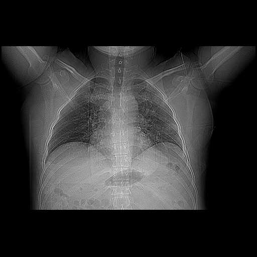 covid-19-pneumonia-8.jpg